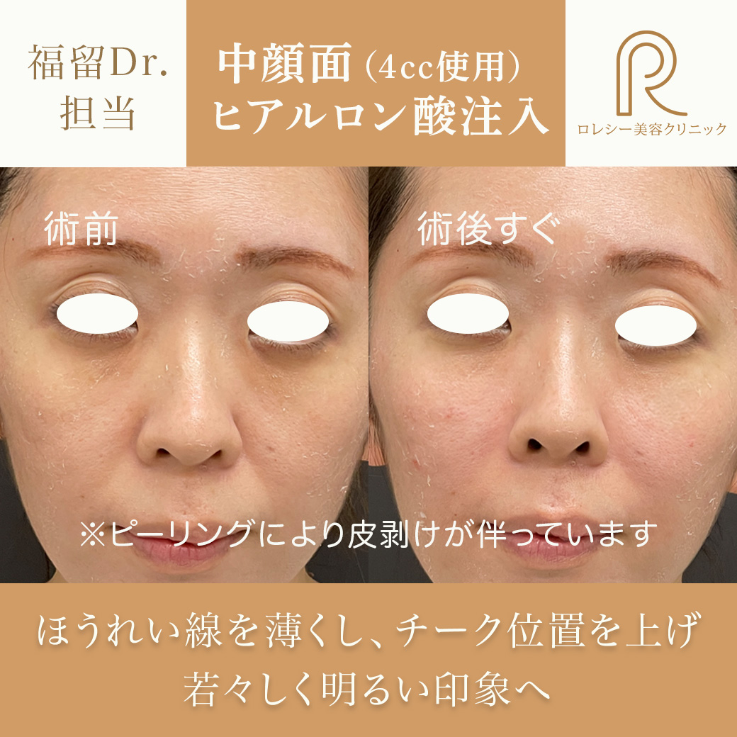 しわたるみほうれい線改善ヒアルロン酸注入症例写真