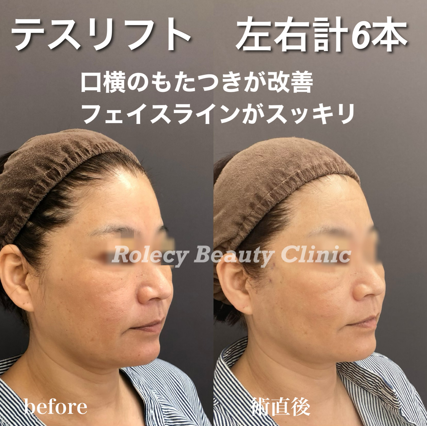 テスリフト症例写真