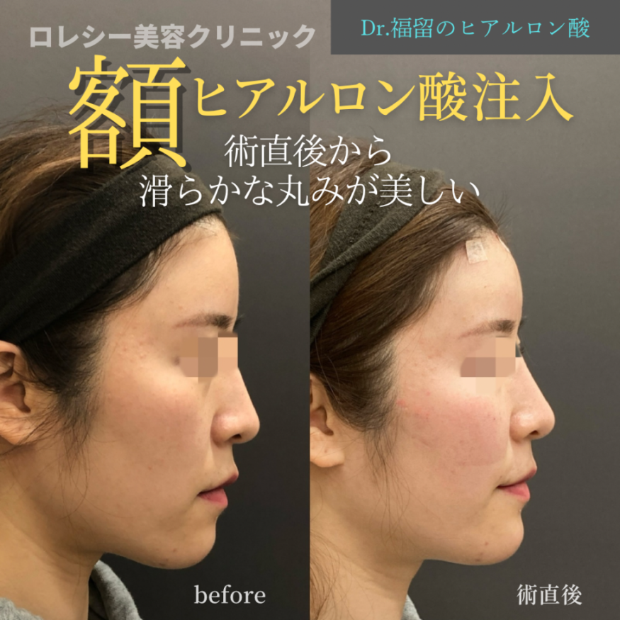 おでこヒアルロン酸注射の症例写真