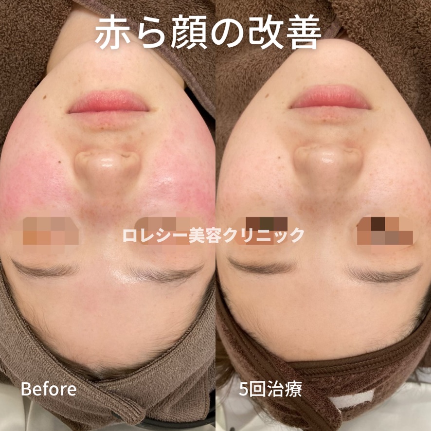 フォトフェイシャル症例写真