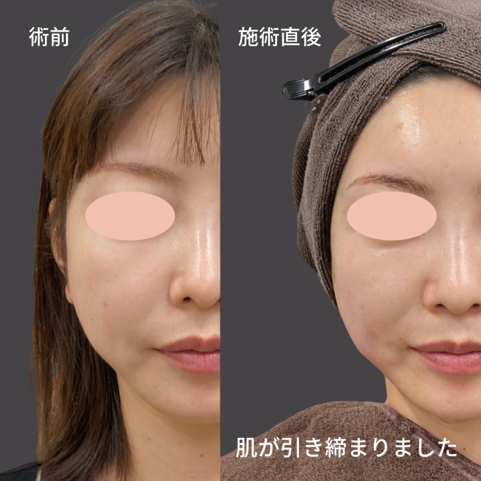 HIFU全顔フル症例写真