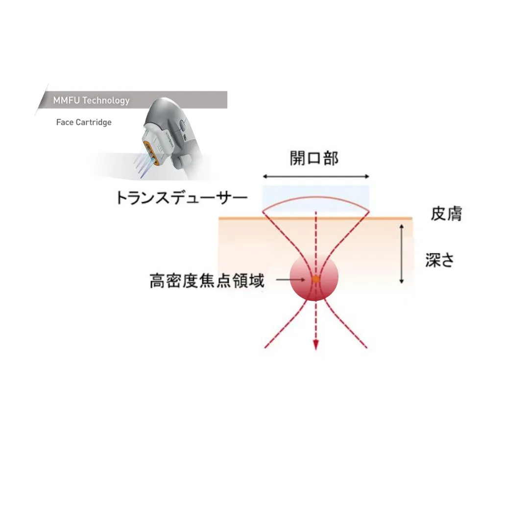 医療ハイフを照射したときに起こる肌内部のイメージイラスト