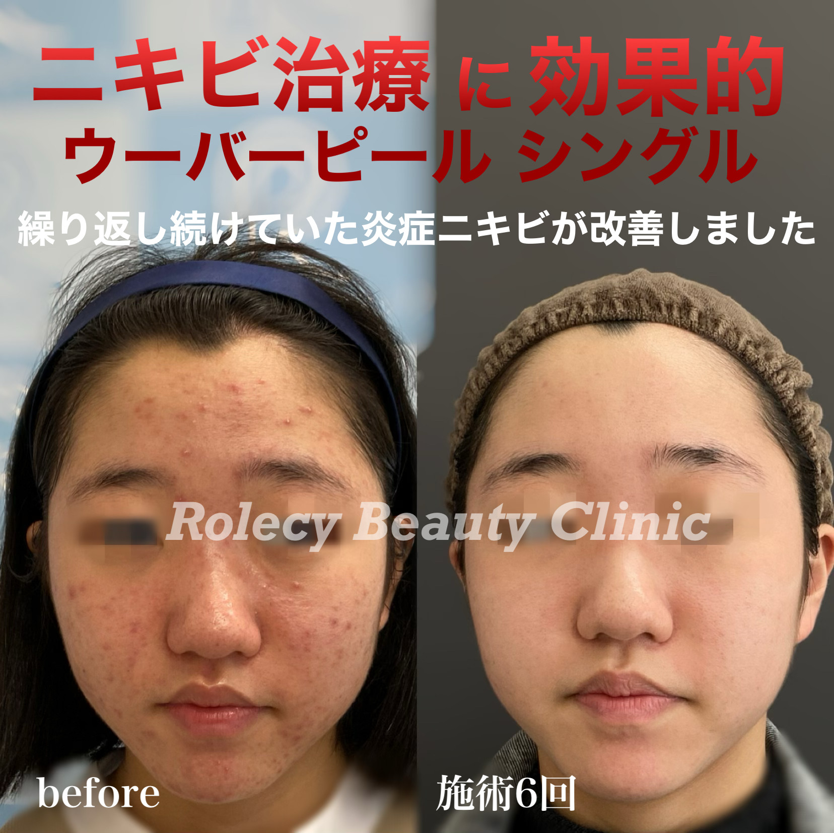 ウーバーピールシングル6回施術の症例写真