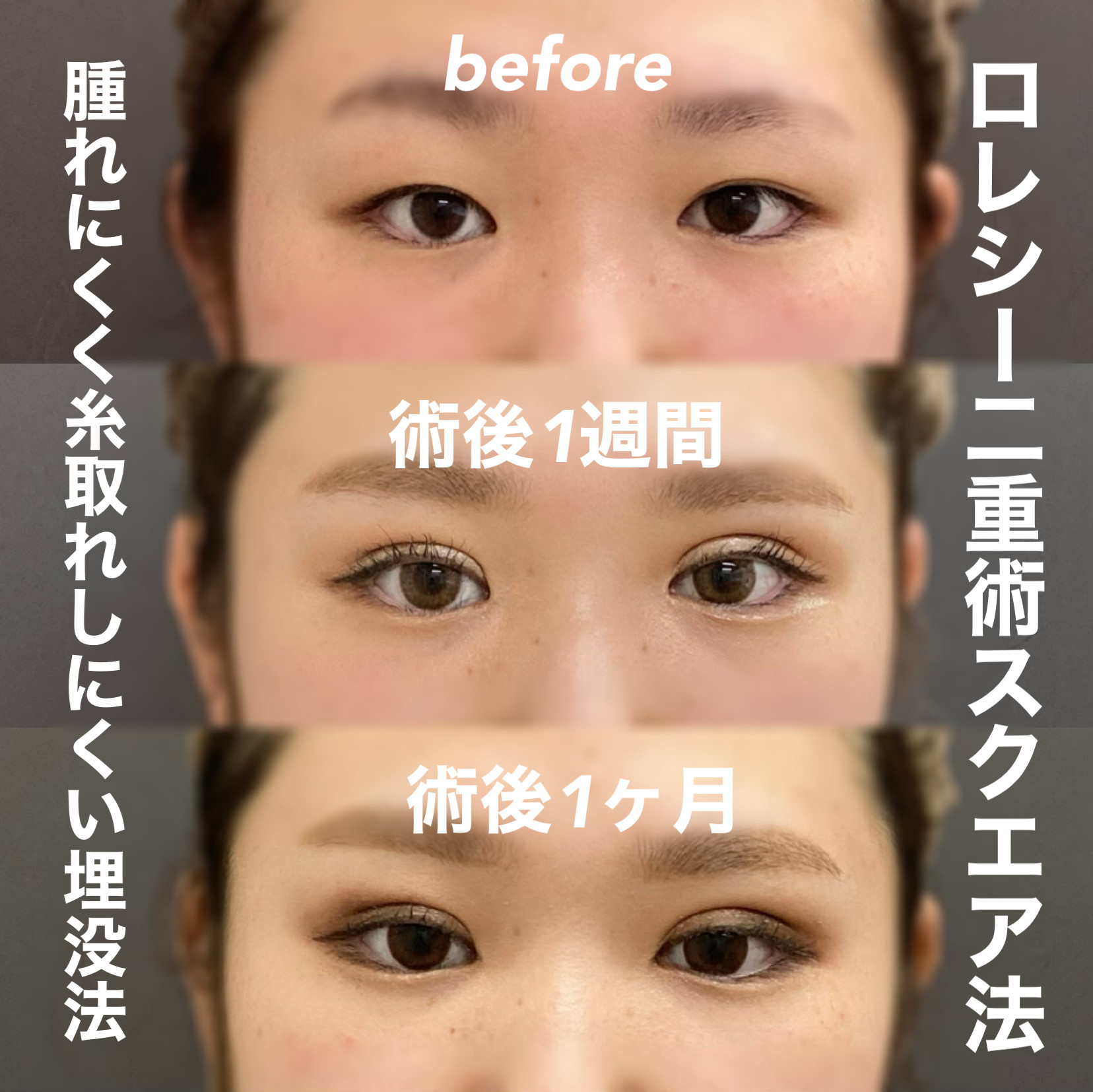 埋没二重症例写真