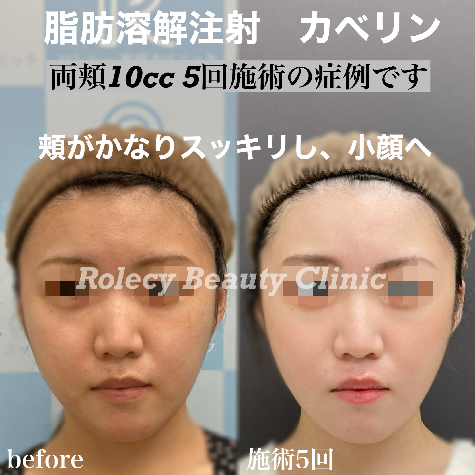 カベリン両頬10cc 5回施術症例写真