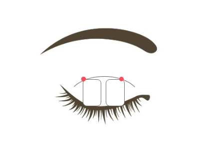 ロレシー二重術スクエア法イラスト