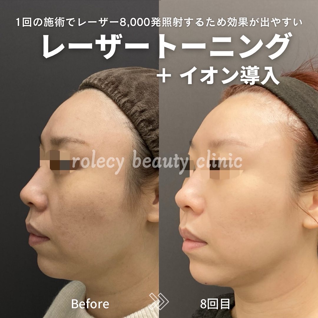 レーザートーニング5回+イオン導入5回症例写真