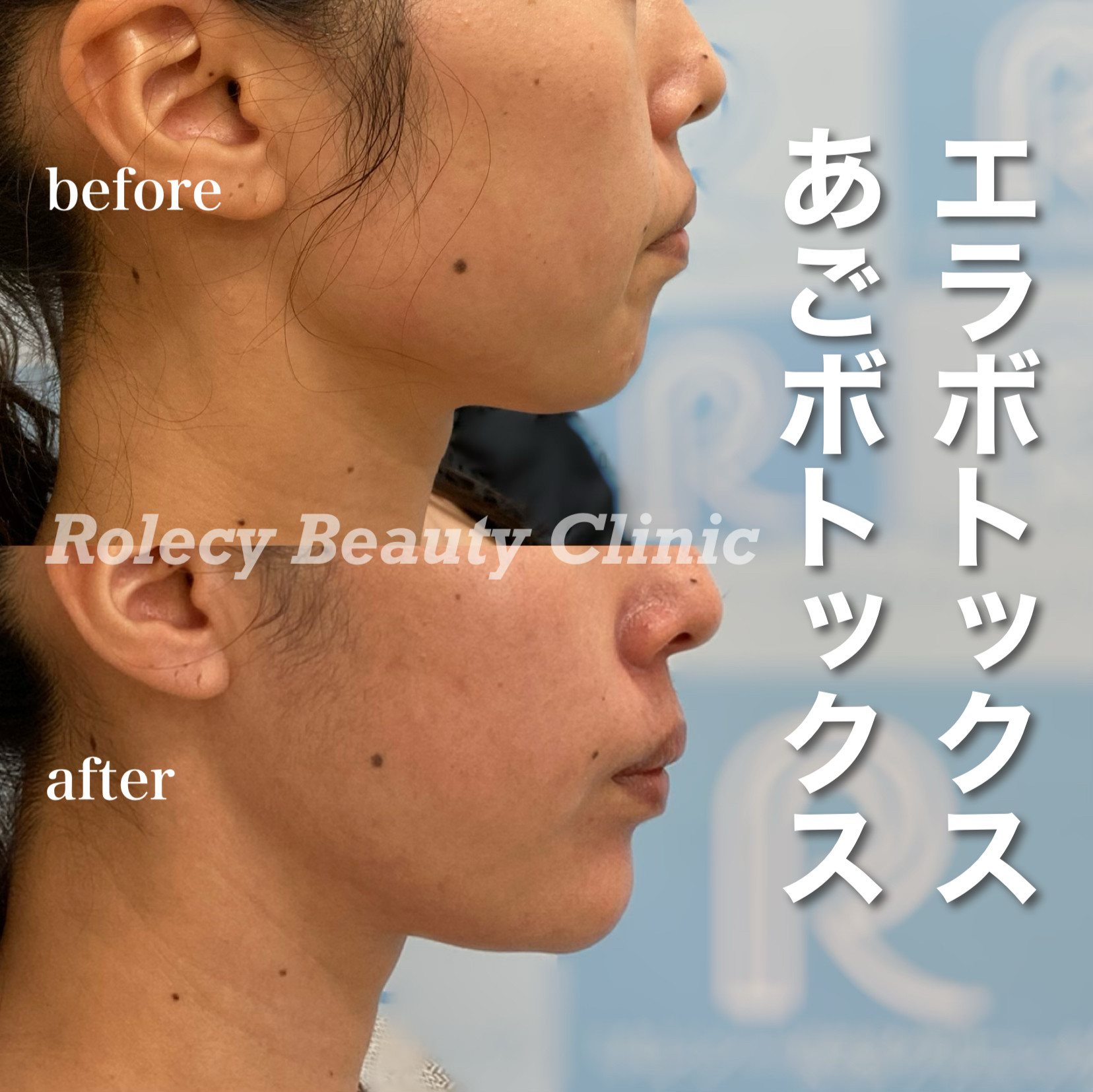 エラ・あごボツリヌス注射症例写真