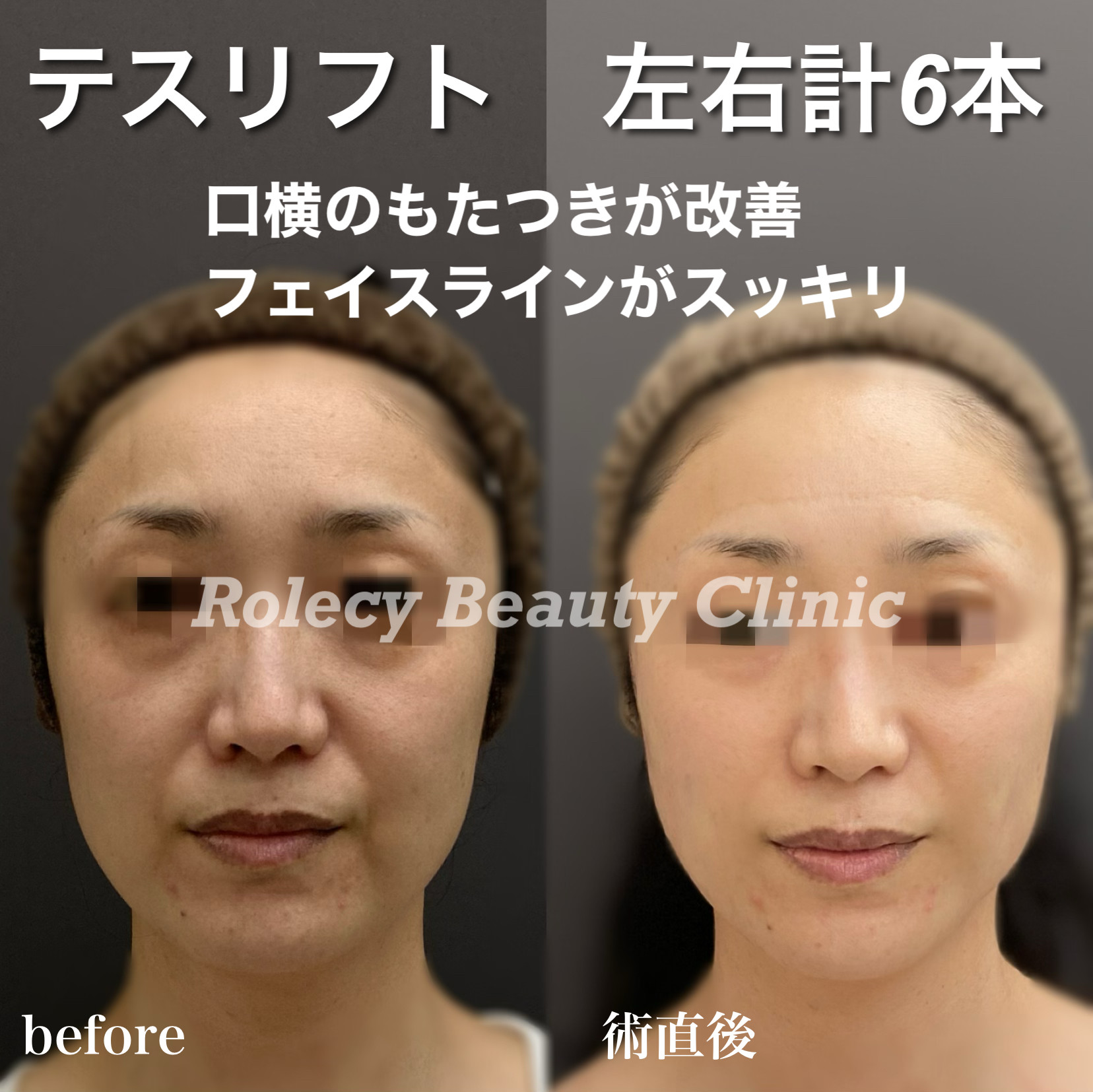 テスリフト症例写真