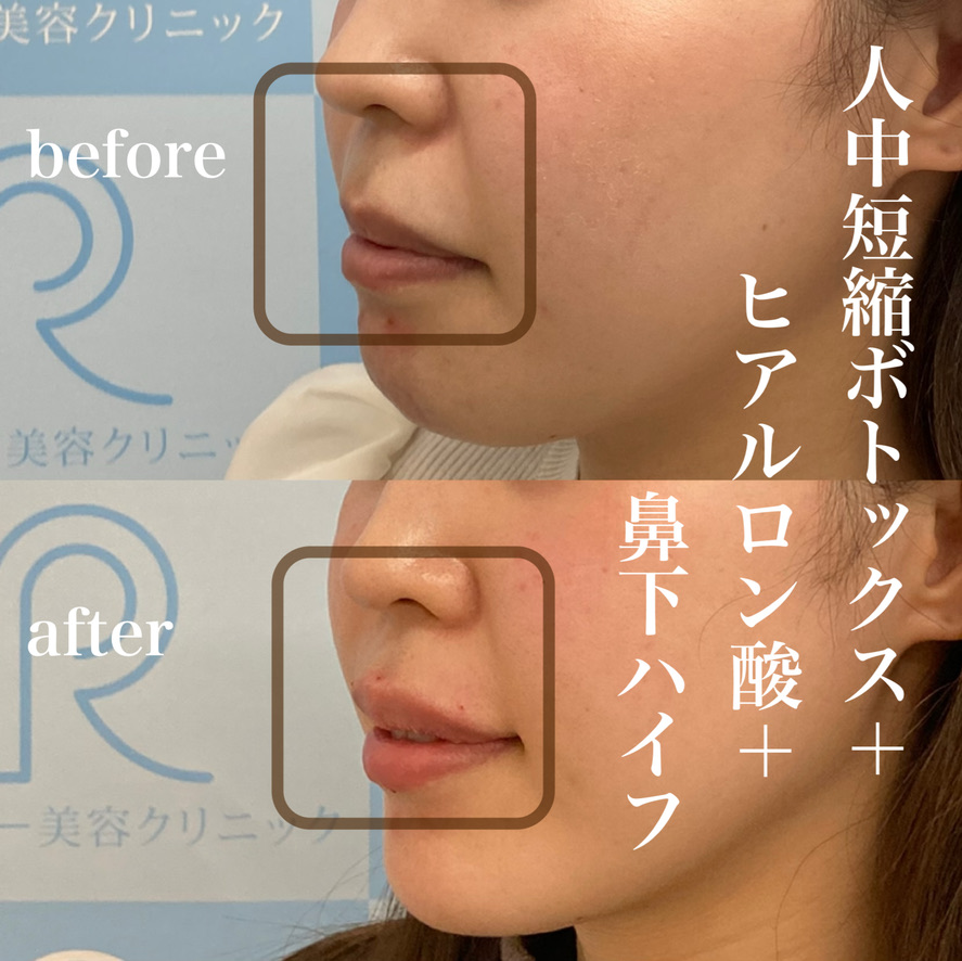 人中短縮ボツリヌス注射+ハイフ+ヒアルロン酸注入(リップ)