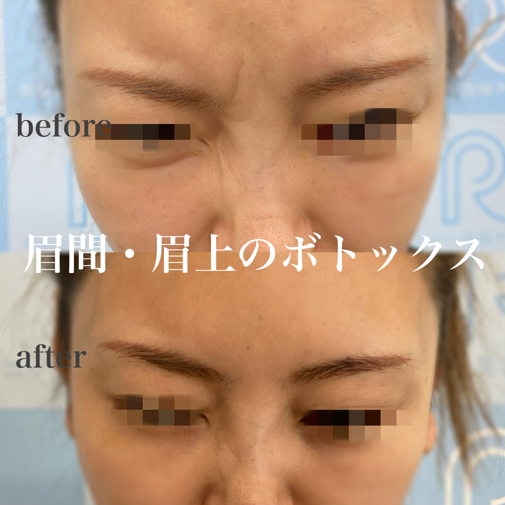 眉間・眉上ボツリヌス注射症例写真