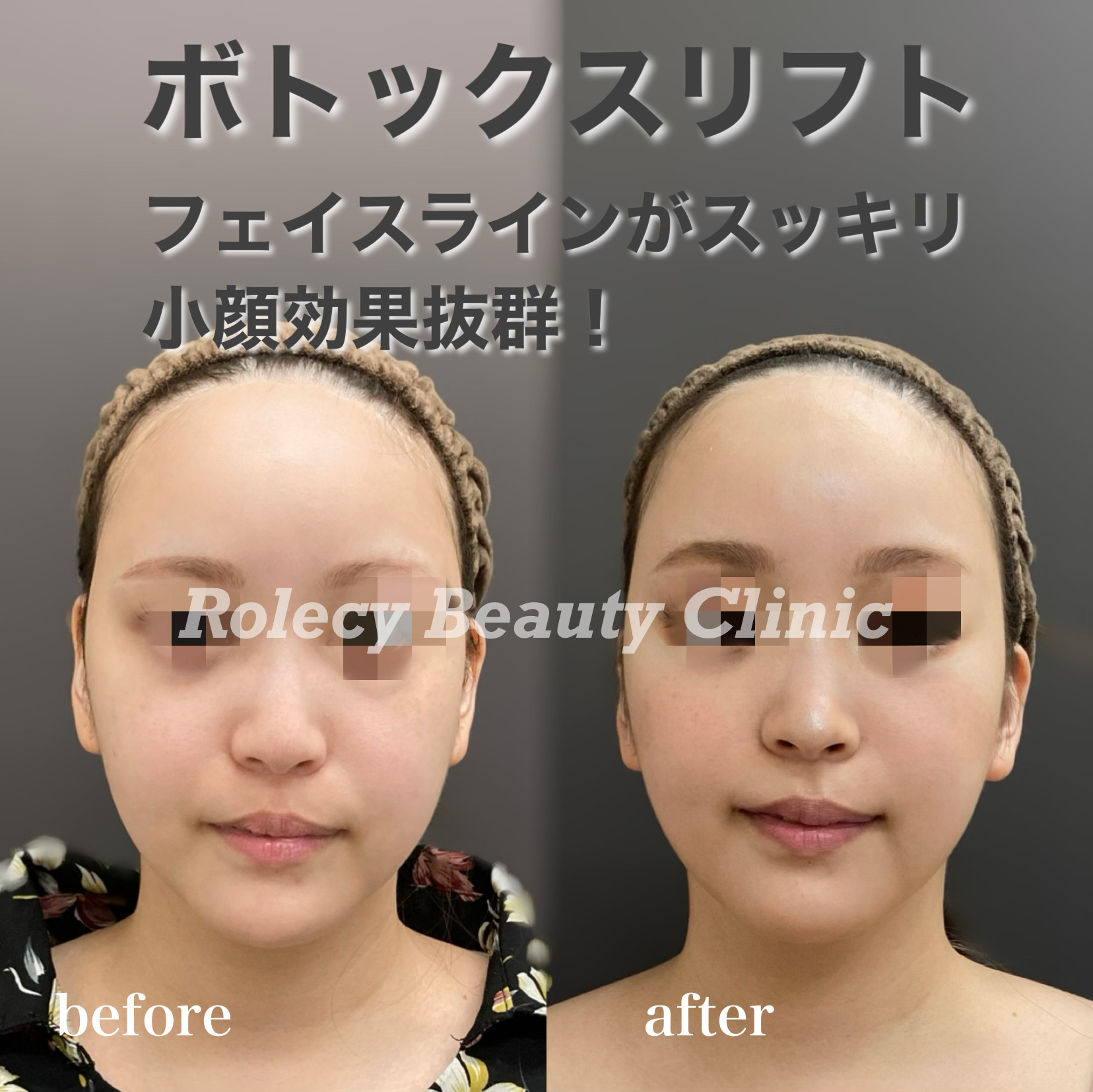 ボツリヌスリフト症例写真