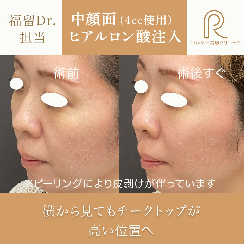 しわたるみほうれい線改善ヒアルロン酸注入症例写真