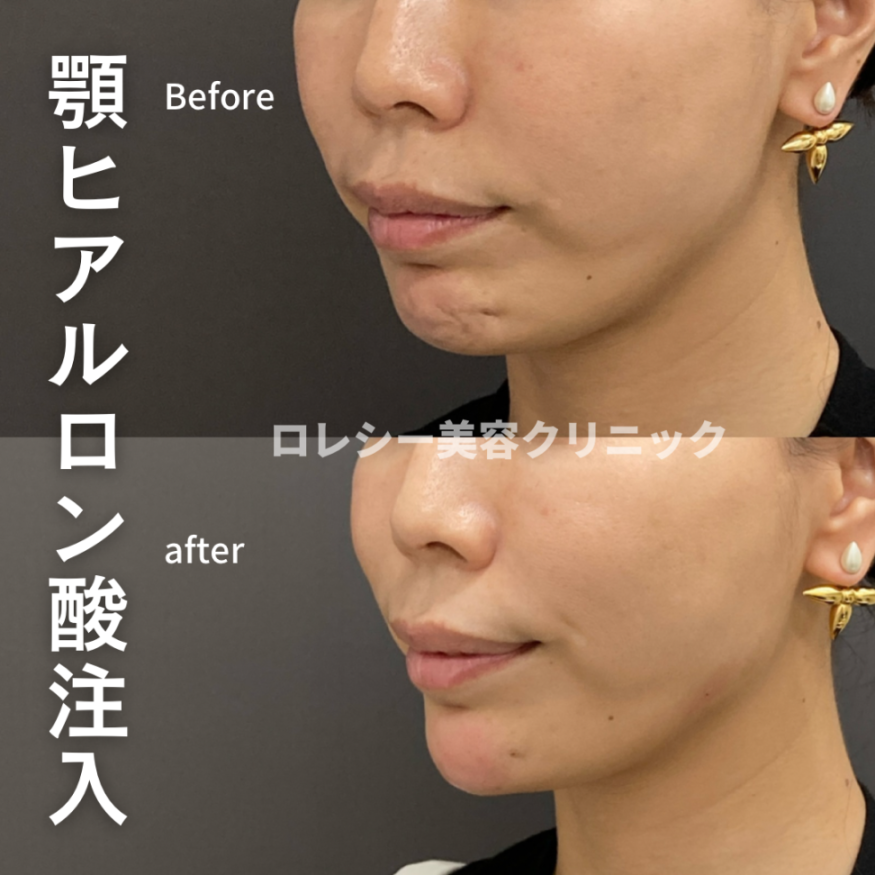 顎ヒアルロン酸の症例写真