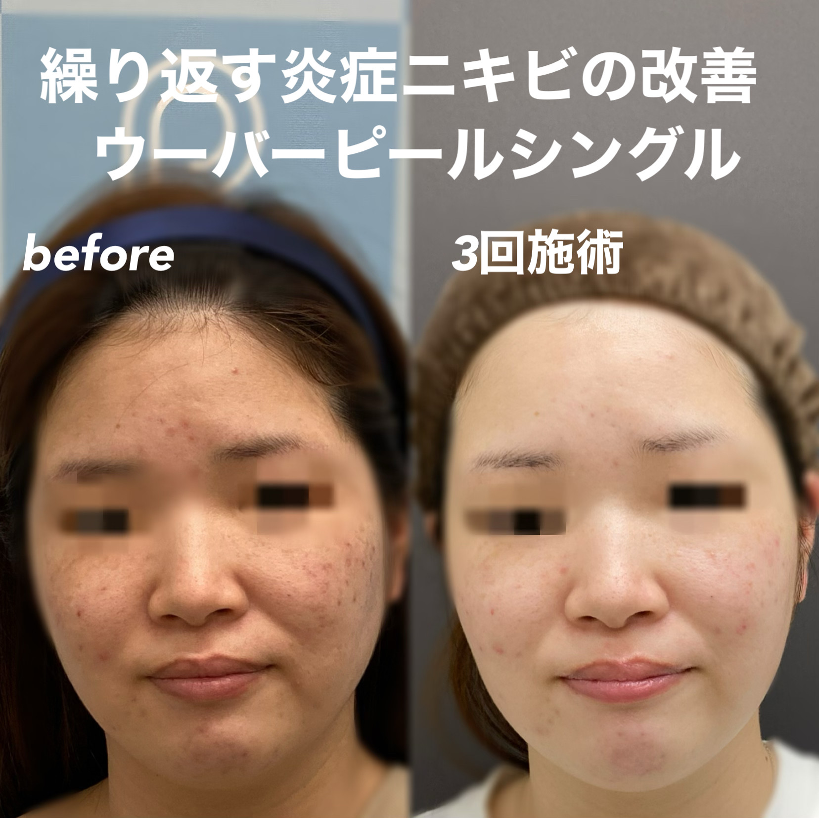 ウーバーピールシングル3回施術の症例写真