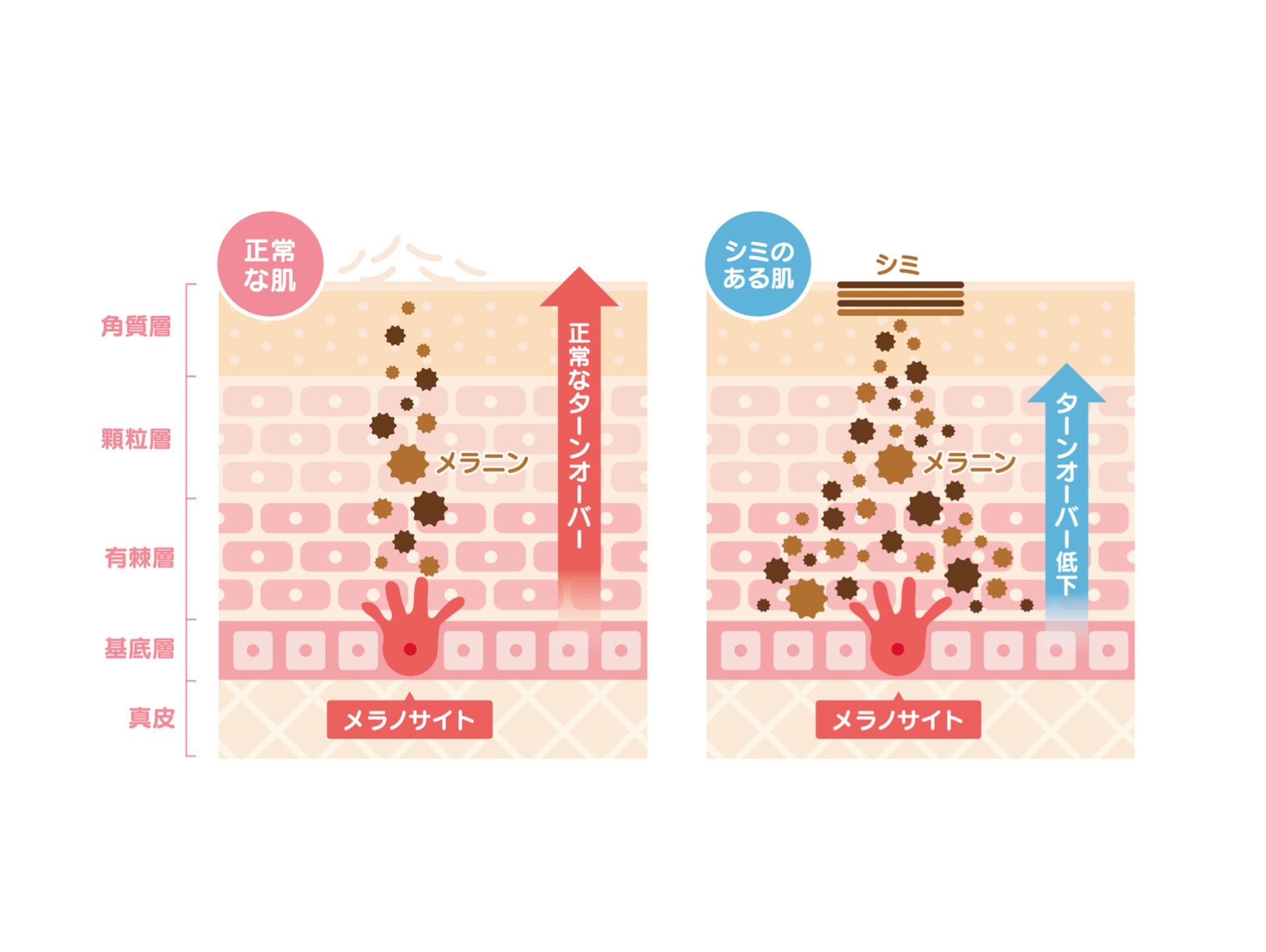 レーザー照射がしみに反応するイメージイラスト