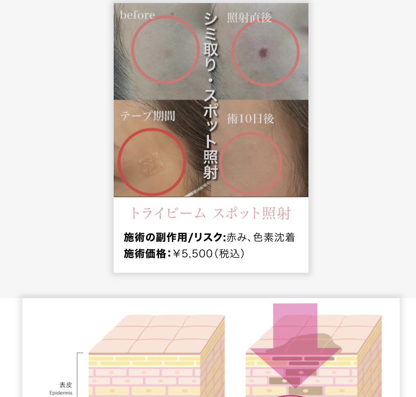 シミ取りレーザースポット照射の症例写真