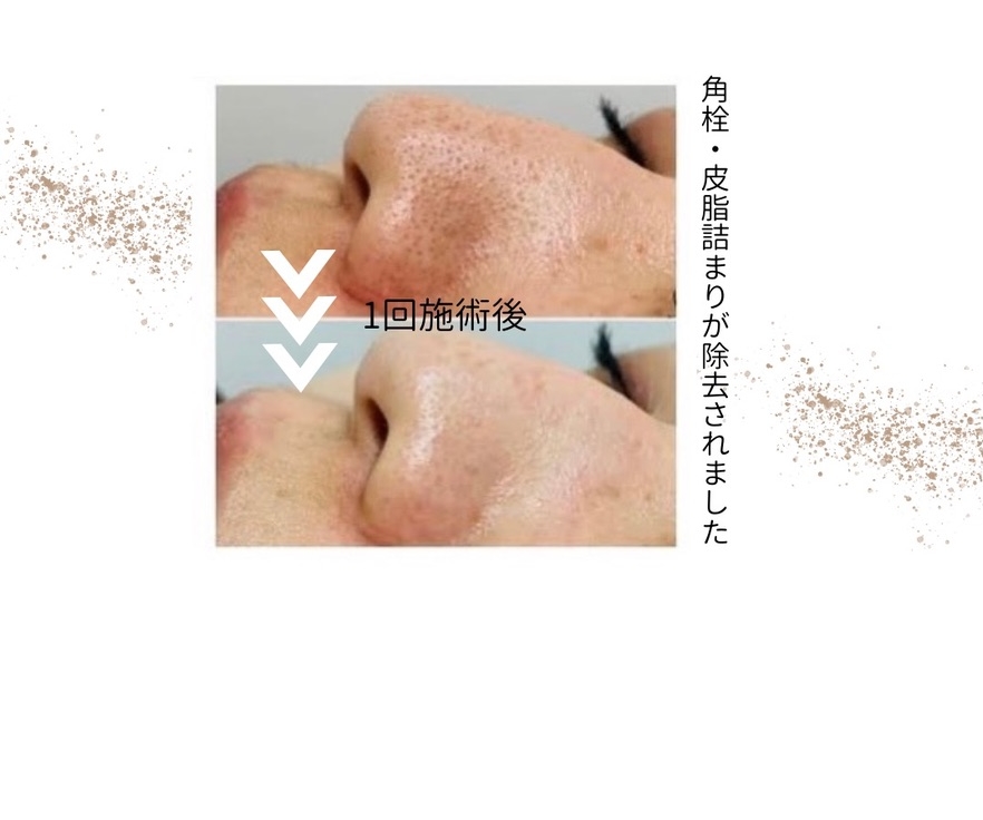 角栓が除去された写真