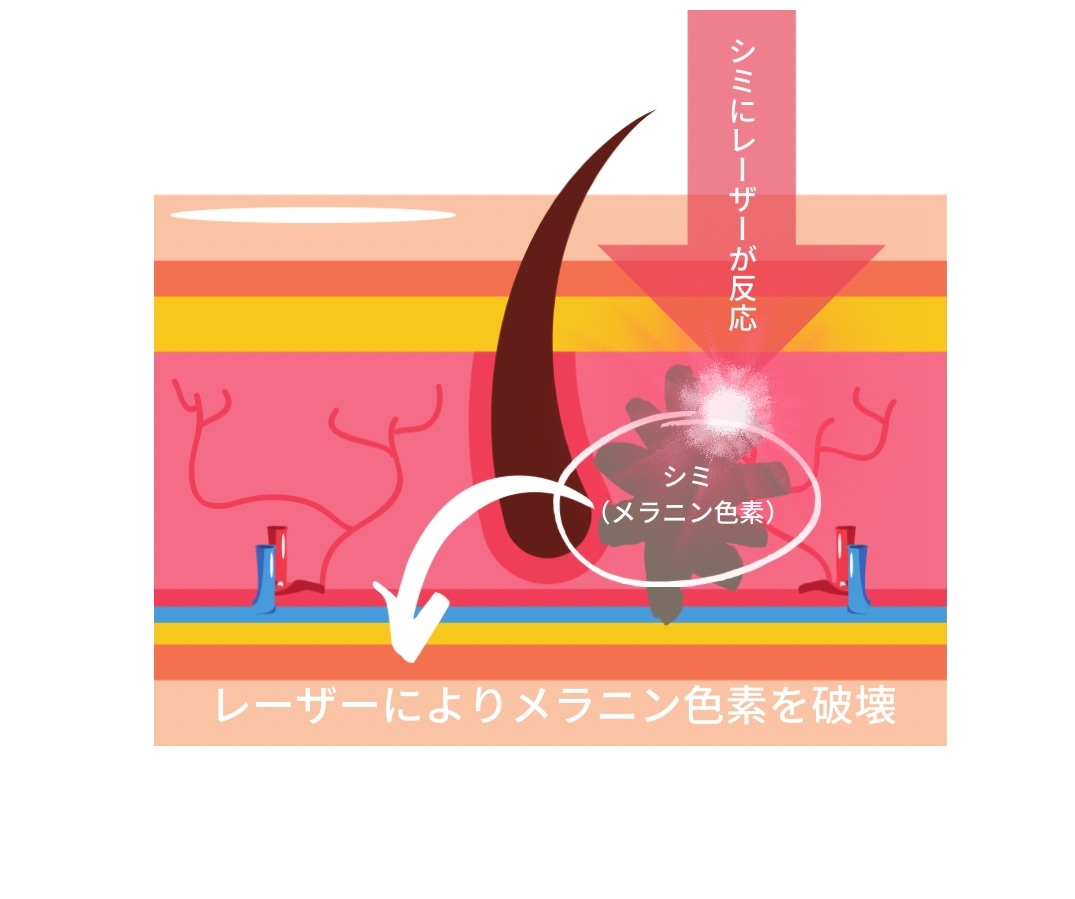 レーザー照射がしみに反応するイメージイラスト