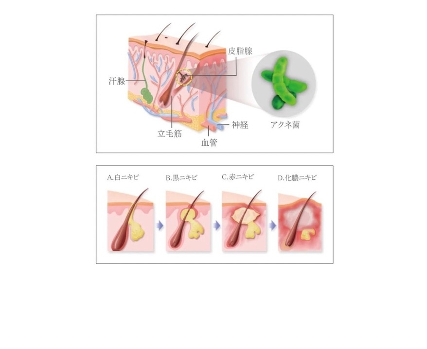 ニキビのイラスト