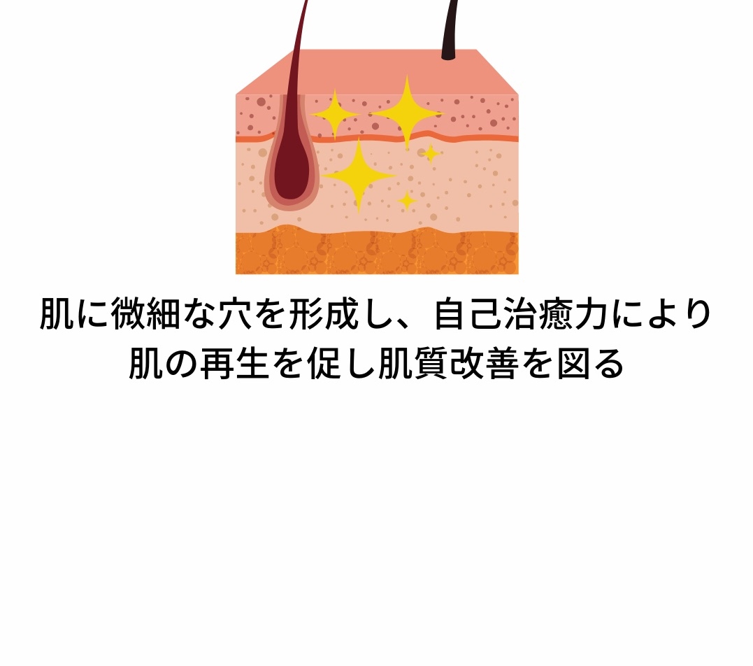 ヴェルベットスキン の施術をした後の肌の経過をイメージした肌断面図のイラスト