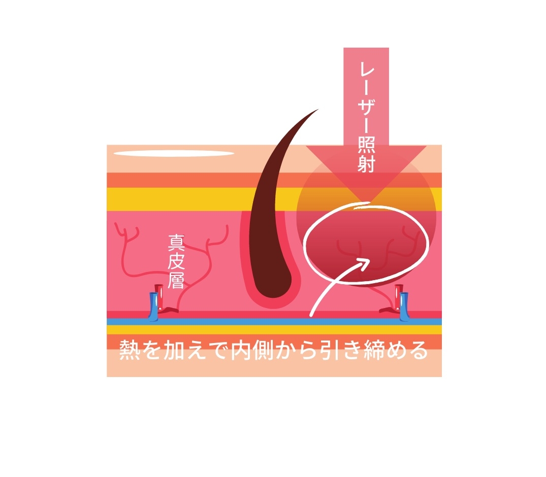 レーザー照射が皮膚内に起こす作用をイメージしたイラスト